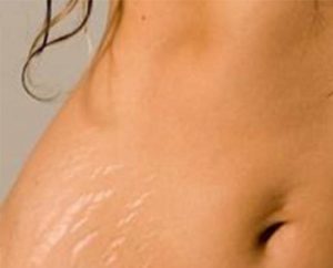 Tratamiento de estrías y manchas de la piel